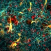 An image of confocal cancer cells and fibroblasts in collagen